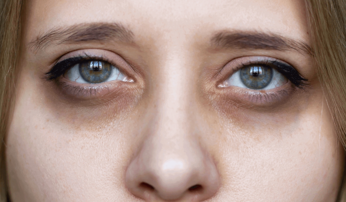 Best Dark Circle Treatment in Jubilee Hills