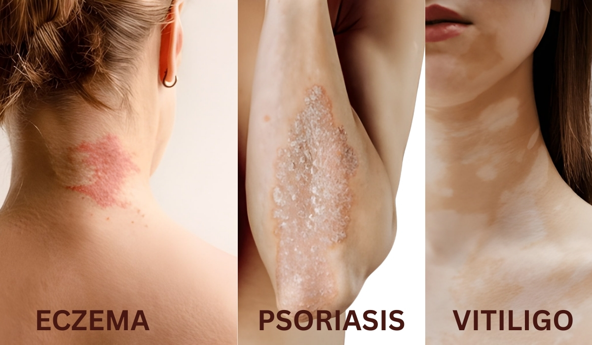 Eczema treatment in Jubilee Hills
